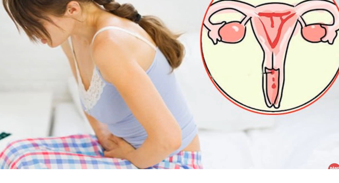 Ung thư cổ tử cung nên ăn và kiêng những gì?Polyp tử cung