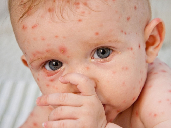 Hội chứng Rubella bẩm sinh ảnh hưởng như thế nào tới thai nhi?