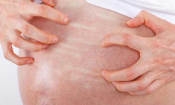 Mẹ bầu bị ngứa có phải là điều bình thường?