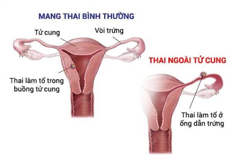 Mang thai ngoài tử cung: Dấu hiệu và nguyên nhân