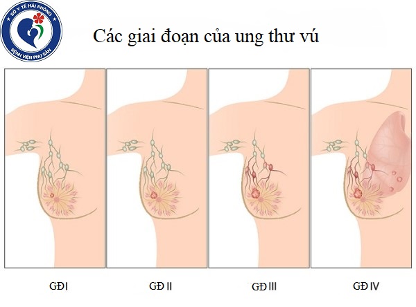 Ung thư vú - Nguyên nhân và các giai đoạn phát triển