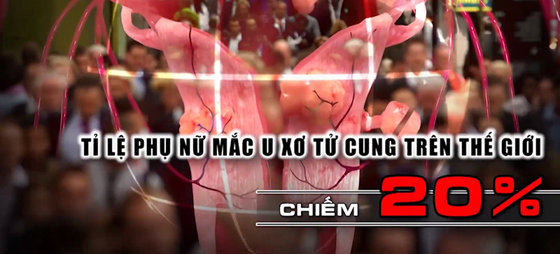 U xơ tử cung có cần thiết phải mổ khôngU xơ tử cung có cần thiết phải mổ không, những điều bạn cần biết về u xơ tử cung
