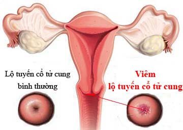 Các cấp độ của viêm lộ tuyến tử cungViêm lộ tuyến cổ tử cung