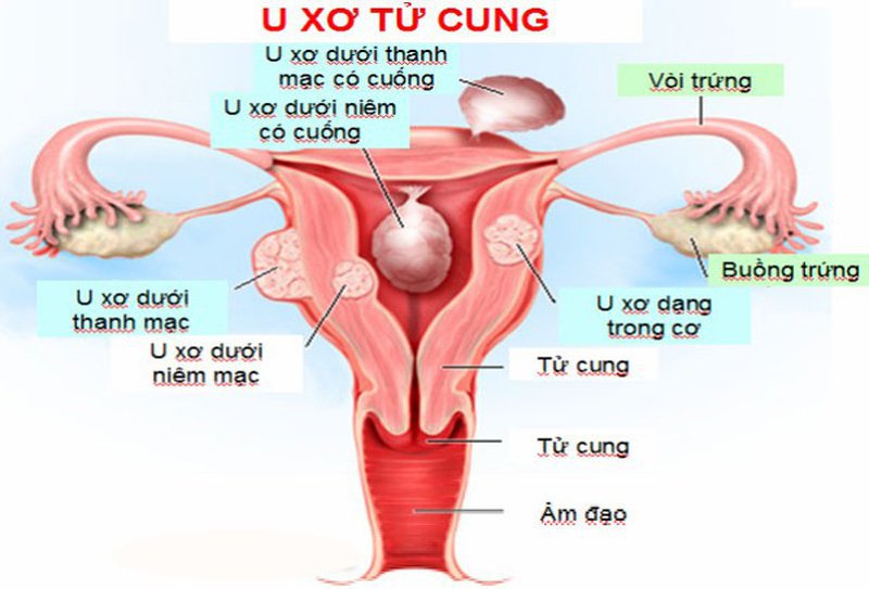 Bệnh u xơ tử cung: nguyên nhân, triệu chứng & điều trịU xơ tử cung