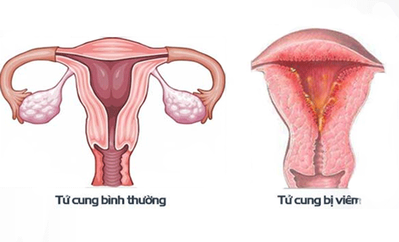 Viêm nội mạc tử cung: Nguyên nhân, triệu chứng, dấu hiệu nhận biếtViêm nội mạc tử cung