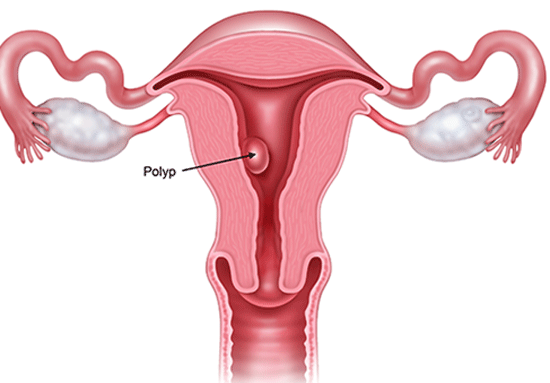 Polyp lòng tử cung có nguy hiểm không?Polyp tử cung