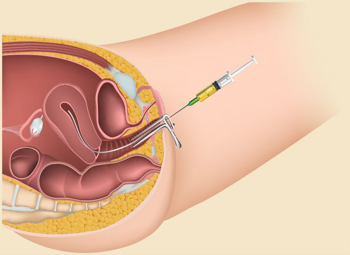 Bị tắc vòi trứng có thụ tinh nhân tạo được không?