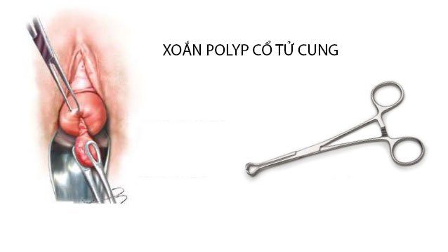 Thủ thuật xoắn polyp cổ tửPolyp tử cung