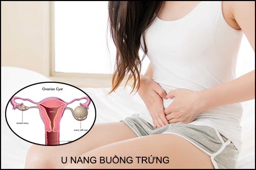 Những điều cần biết về u nang buồng trứng