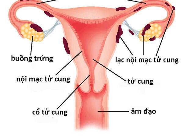 Lạc tuyến nội mạc tử cung là bệnh gì?