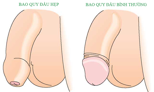 Hẹp bao quy đầu là gì?Hẹp bao quy đầu