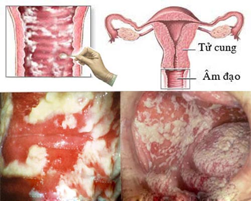 5 nguyên nhân phổ biến gây viêm âm đạoKhí hư bất thường