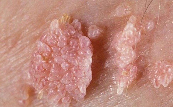 Tổng quan về cắt-đốt sùi mào gà và những điều cần biết