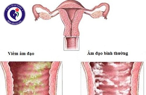 Viêm âm đạo: Nguyên nhân và triệu chứng nhận biết