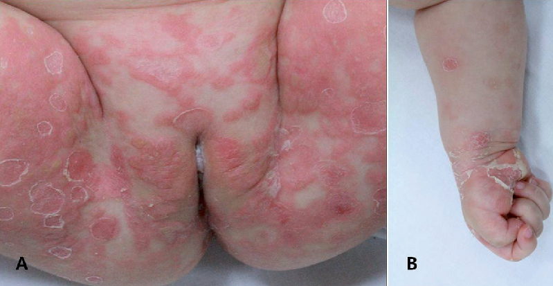 Bệnh giang mai - Nguyên nhân và cách phòng chống