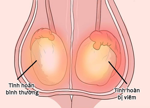 Viêm tinh hoàn và những điều cần biết