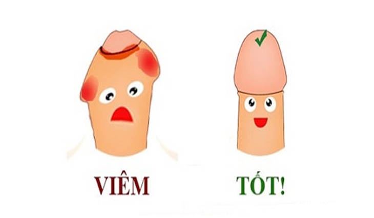 Những nguyên nhân nào gây viêm bao quy đầu?