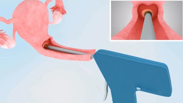 Áp lạnh viêm lộ tuyến cổ tử cung là gì?