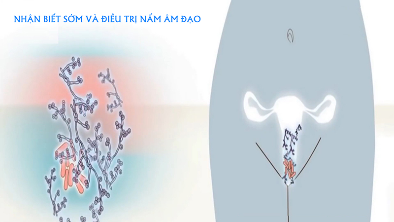 Viêm âm đạo do nấm có lây truyền khi quan hệ tình dục không?Viêm âm đạo do nấm có lây truyền khi quan hệ tình dục không?Viêm âm đạo