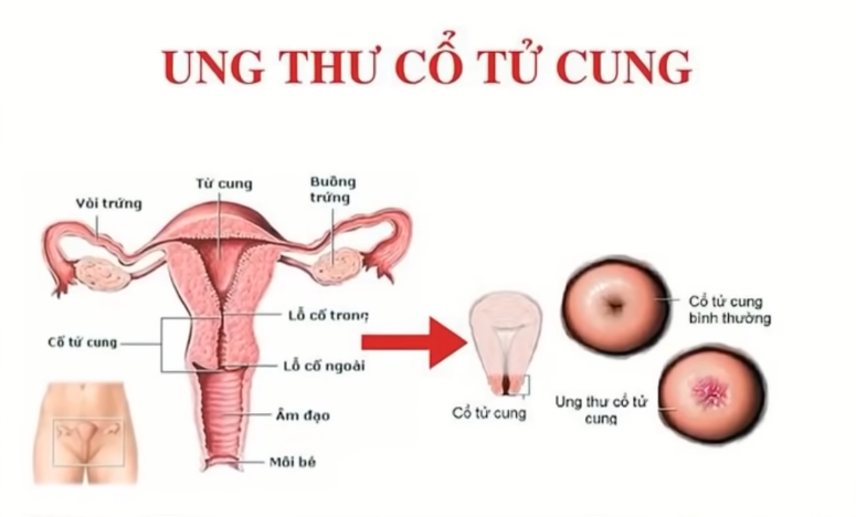 Lứa tuổi nào dễ mắc bệnh ung thư cổ tử cungPolyp tử cung