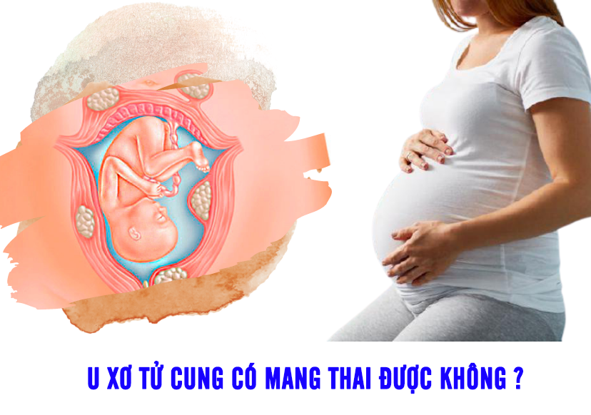 U xơ tử cung có mang thai được khôngU xơ tử cung