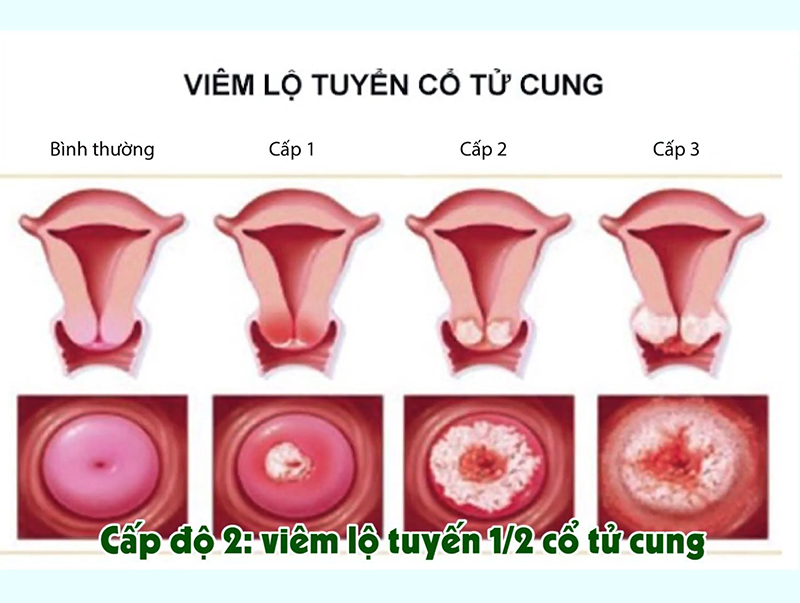 Viêm âm đạo là gì? Các nguyên nhân triệu chứng khi viêm âm đạo?Viêm âm đạo là gì? Các nguyên nhân triệu chứng khi viêm âm đạo?