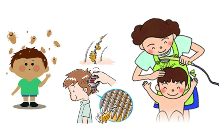 3 lưu ý từ khi sử dụng hạt na và rượu để trị chấy tóc cho trẻ emTin tức xã hội