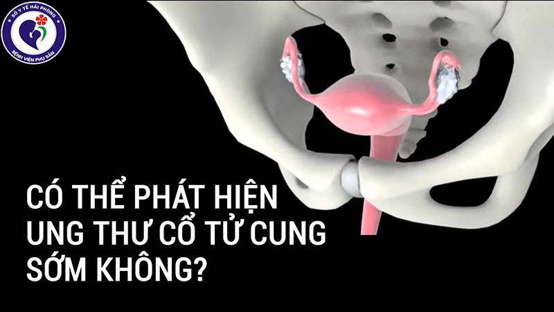 Các dấu hiệu nhận biết ung thư cổ tử cung sớm và cách điều trị hiệu quả