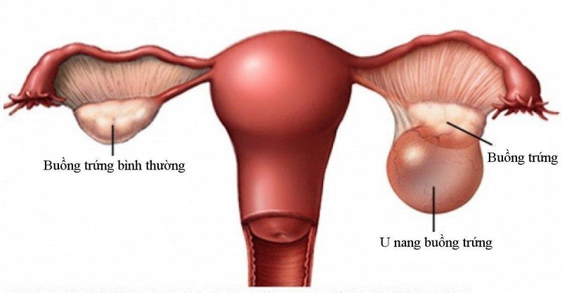 Ưu điểm phương pháp mổ nội soi u nang buồng trứng