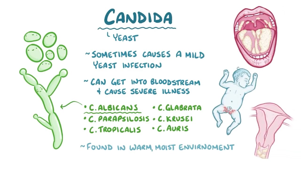Nhiễm nấm candila âm đạo hay viêm âm đạo do nấm candila là gì