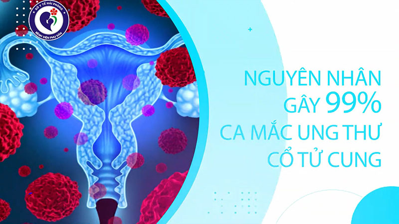 Nguyên nhân và triệu chứng của ung thư cổ tử cung