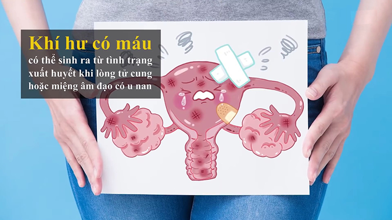 Những thói quen sinh hoạt giúp bạn hạn chế diễn biến của nấm âm đạo
