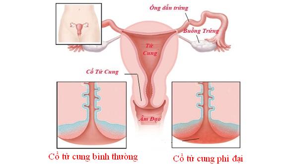 Phì đại cổ tử cung là bệnh gì?Phì đại cổ tử cung
