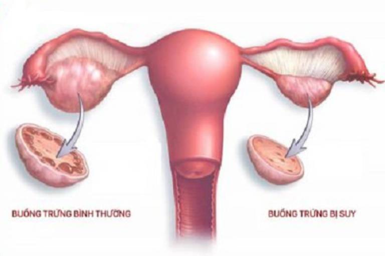 Suy buồng trứng: Nguyên nhân, dấu hiệu, ảnh hưởng của bệnh tới sức khỏe phụ nữSuy buồng trứng sớm
