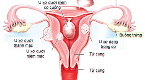 Phát hiện u xở tử cung từ 8 năm nay
