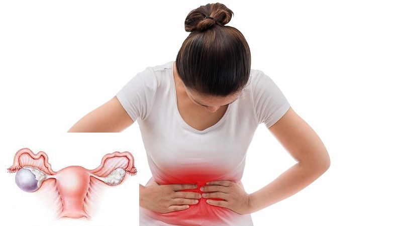 U nang buồng trứng là gì? Phương pháp điều trị không cần can thiệp phẫu thuật