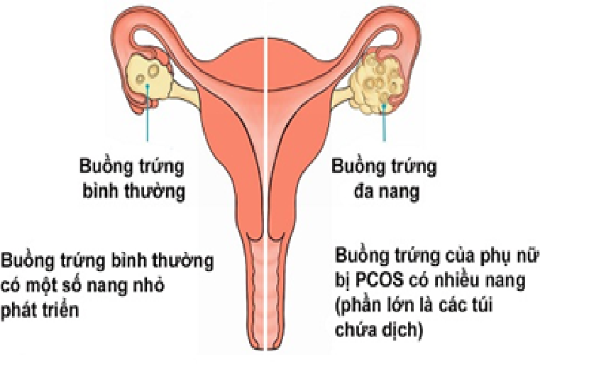 Hội chứng buồng trứng đa nang có con được không