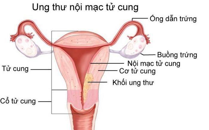 Ung thư nội mạc tử cung: Nguyên nhân, dấu hiệu và giai đoạn phát triển