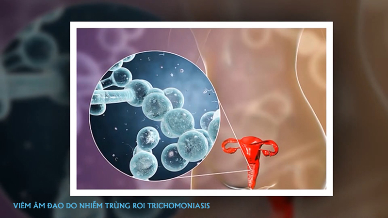 Viêm âm đạo do trùng roi TRICHOMONIASISViêm âm đạo do trùng roi TRICHOMONIASIS điều trị tại bệnh viện phụ sản Hải Phòng