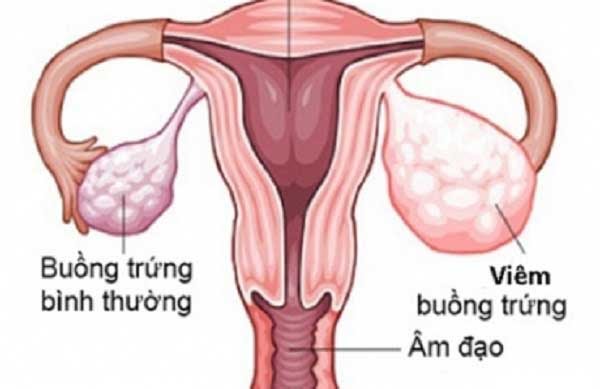 Viêm buồng trứng là gì?Viêm buồng trứng