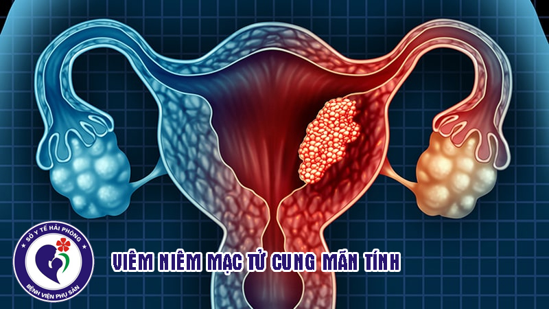 Nghiên cứu ứng dụng kỹ thuật nội soi buồng tử cung kết hợp giải trình tự gen trong tầm soát, điều trị bệnh nhân viêm nội mạc tử cung mạn tính trên các đối tượng vô sinh tại Bệnh viện Phụ sản Hải PhòngTin tức bệnh viện